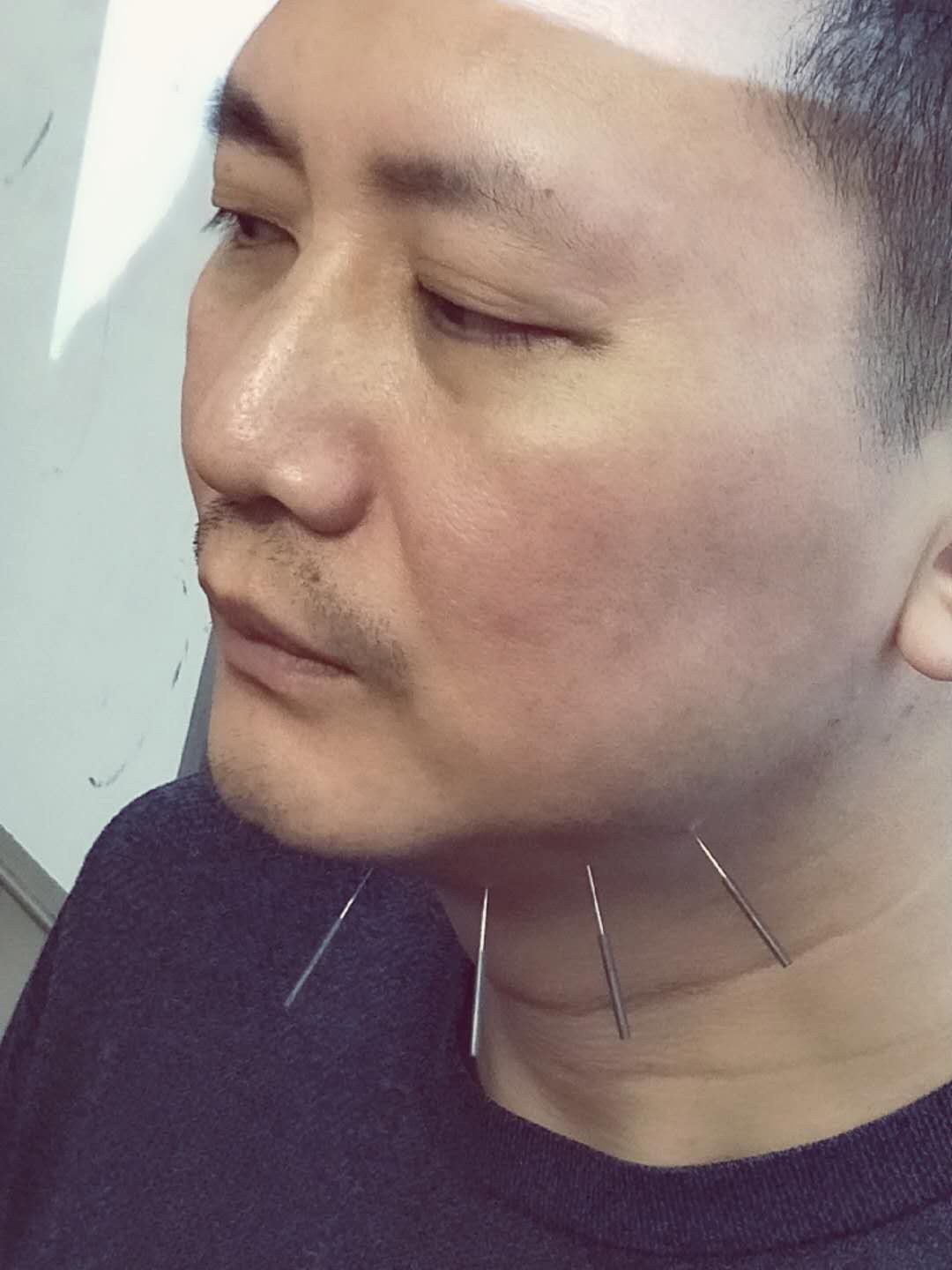 针灸治疗腺体肥大