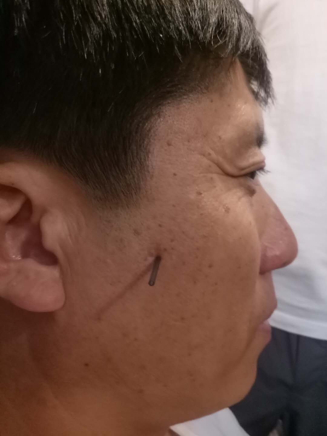 针刺新吾穴治鼻炎