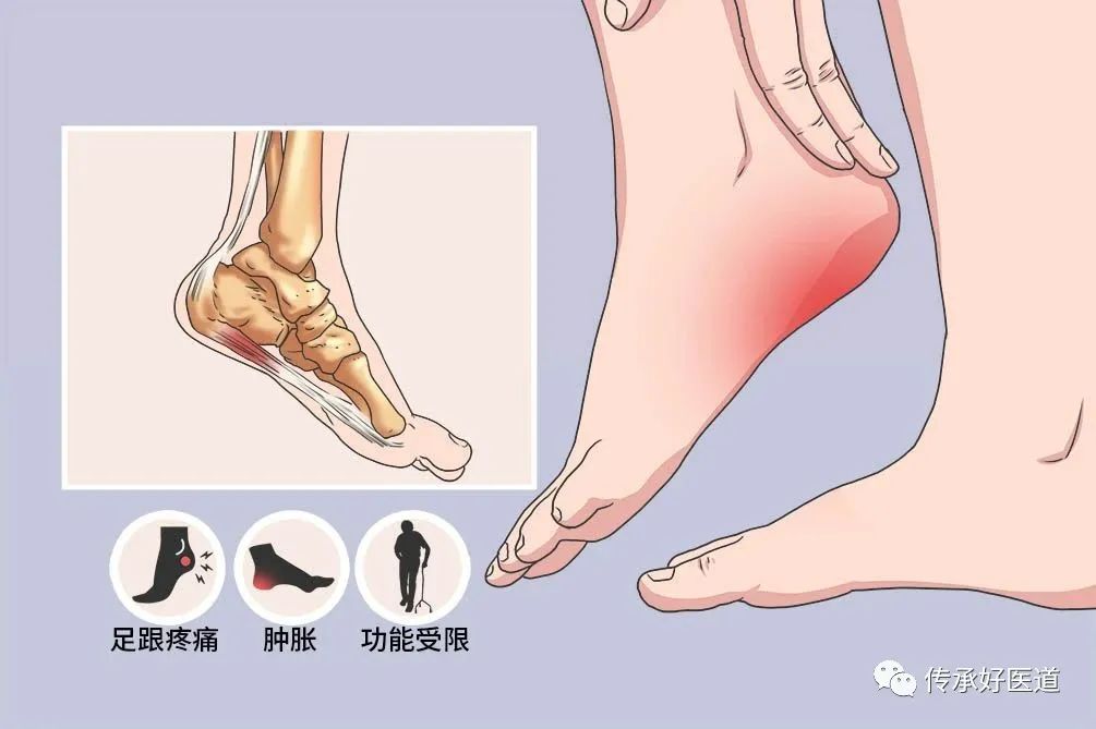 脚底疼痛