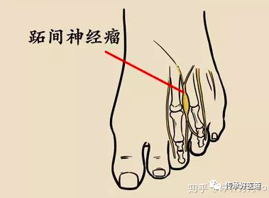 足底筋膜炎